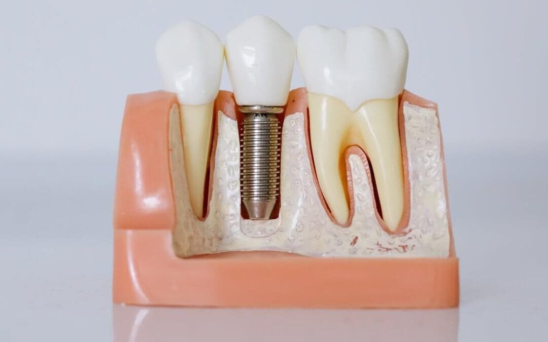 Are Dental Implants Better Than Dentures? Find Out Now