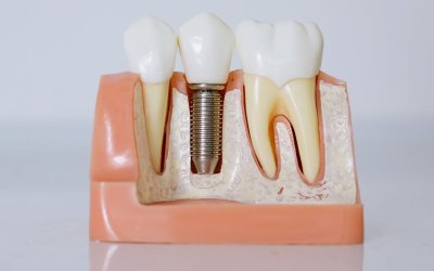 Are Dental Implants Better Than Dentures? Find Out Now